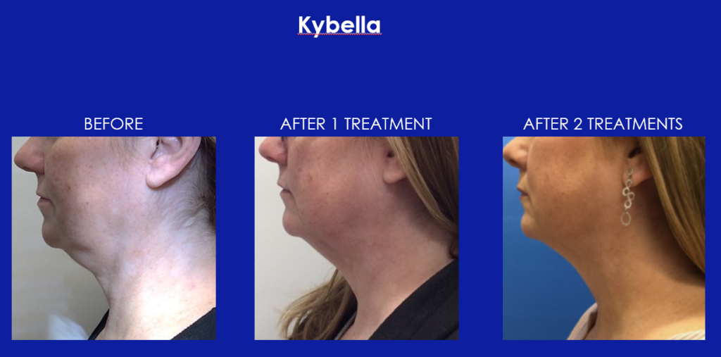 Treating double chin with Kybella injections