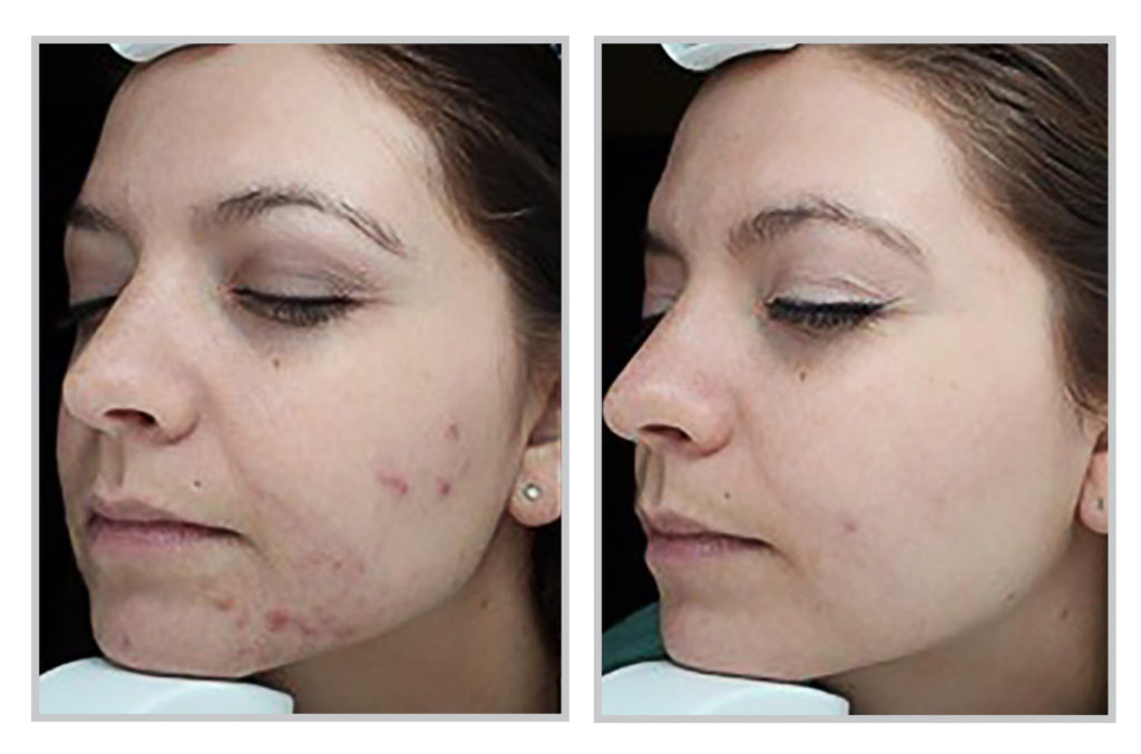 Forever Young BBL Treatment for Acne
