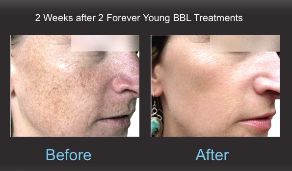Forever Young BBL - Dy Dermatology Center - Before and After