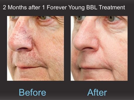 Forever Young BBL - Dy Dermatology Center - Before and After Nose Chin