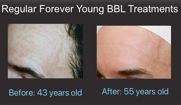 Forever Young BBL - Dy Dermatology Center - Before and After