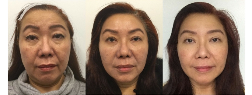 Facial Rejuvenation Treatments by Dr. Lady Dy of Dy Dermatology Center