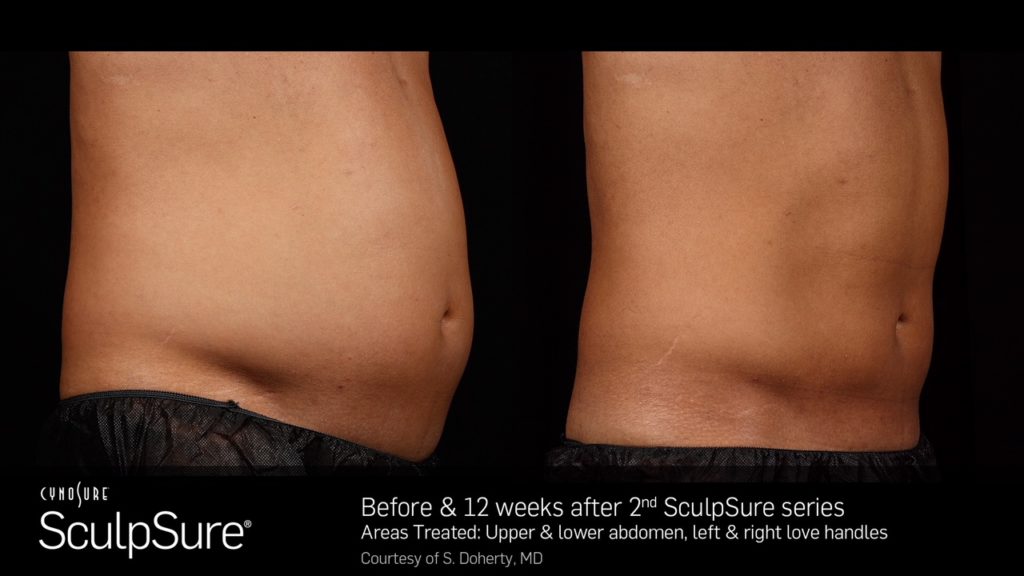 SculpSure Before and After Comparison Photos