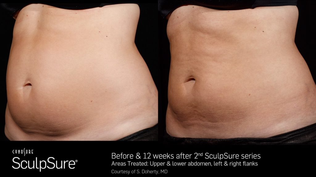 SculpSure Before and After Comparison Photos from Dr. Lady Dy at Dy Dermatology.