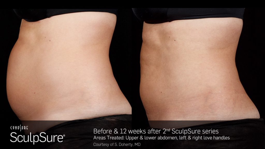 SculpSure Before and After Comparison Photos from Dr. Lady Dy at Dy Dermatology.