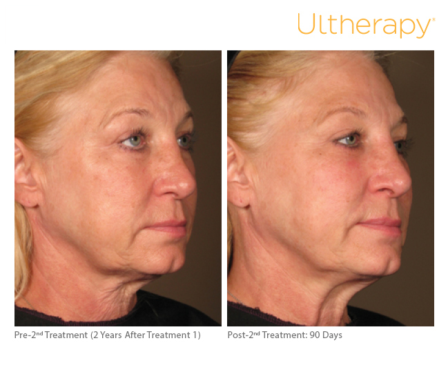 photo of a woman's face showing before and after shots from ultherapy