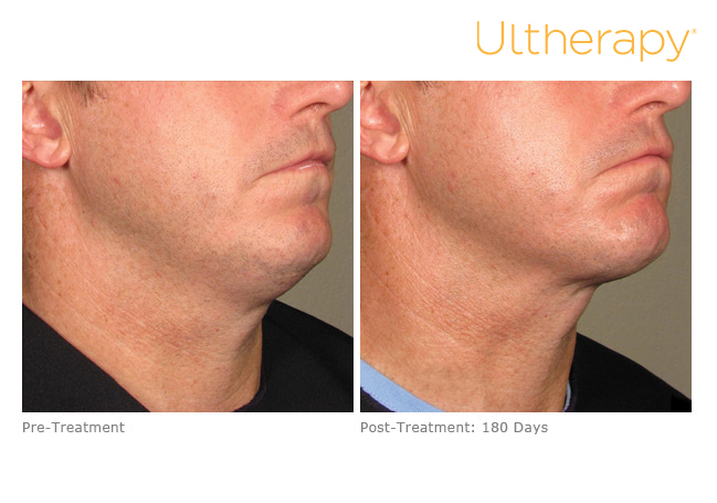 Images showing before a man's neck before and after Ultherapy