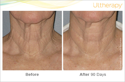 ultherapy photos showing before and after images of a woman's neck