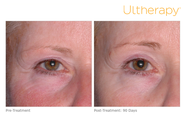 photo showing a woman before and 90 days after ultherapy treatment around her eyes
