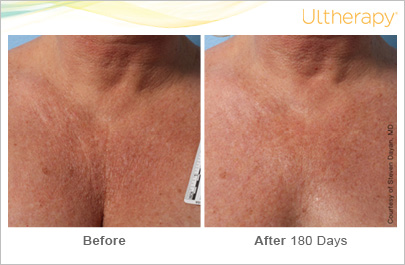 Photo showing a woman's chest before and after 180 days of ultherapy