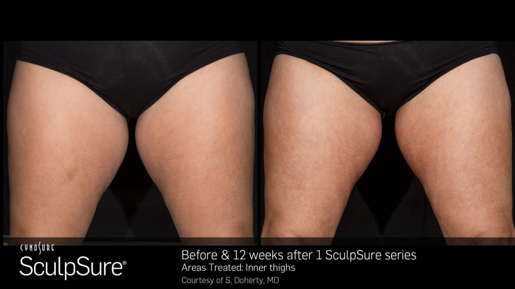 SculpSure before and after photos of a womans thighs