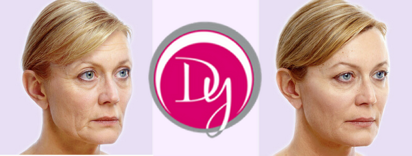 Derm Fillers Dy Dermatology