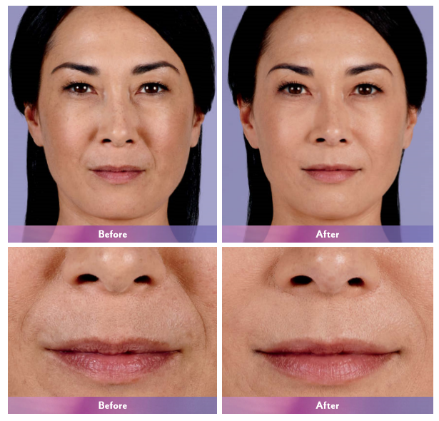 Before and after photos: juvederm lip treatment