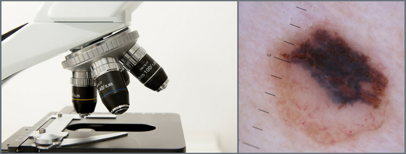 Image of microscope and example of melanoma