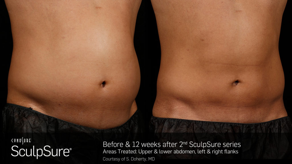 SculpSure Before and After photos showing a males abdomen.