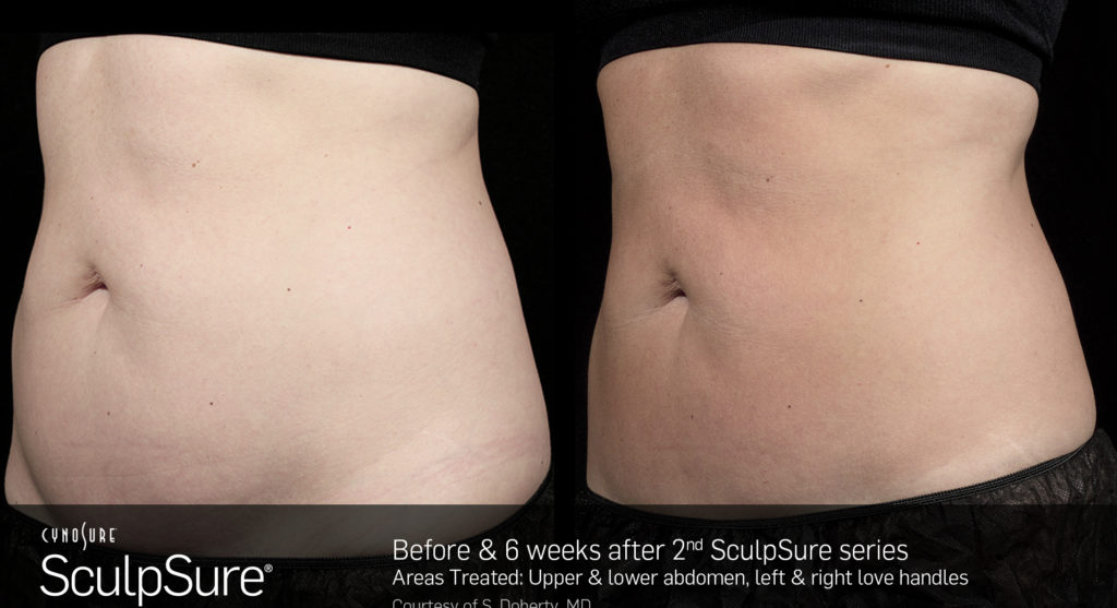 Sculpsure Before & After photos showing the side abdomen of a woman.