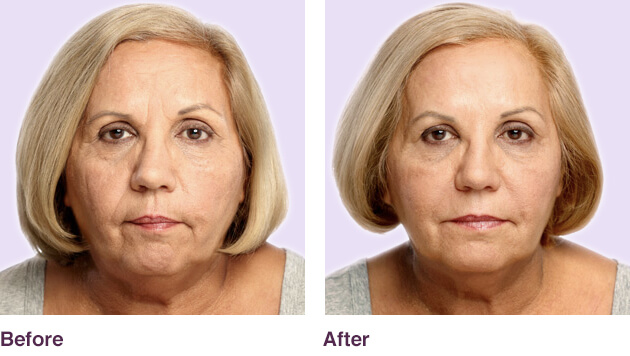 Before and after photos of a juvederm treatment.