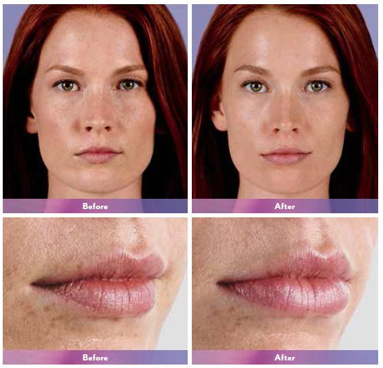 Photos showing a woman before and after having Juvederm treatment to her lips.