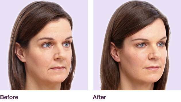 Before and after photos of a juvederm treatment.