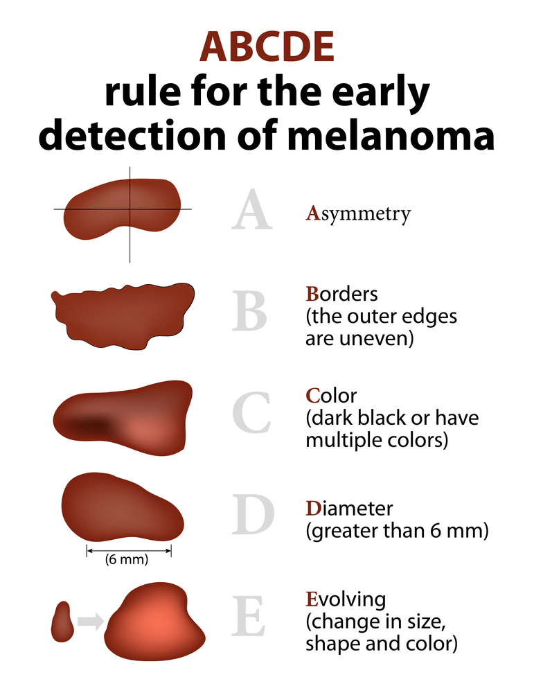 Image: ABCDE Rule for early detection of melanoma