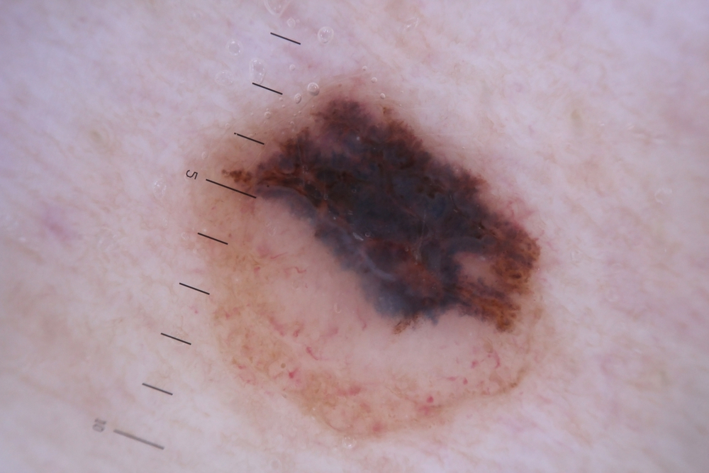 Image: Melanoma in a mole