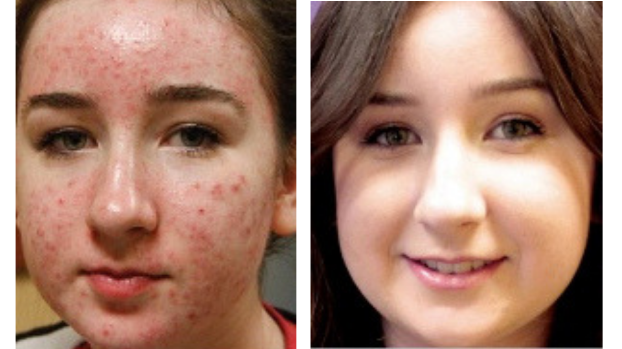 before and after acne image