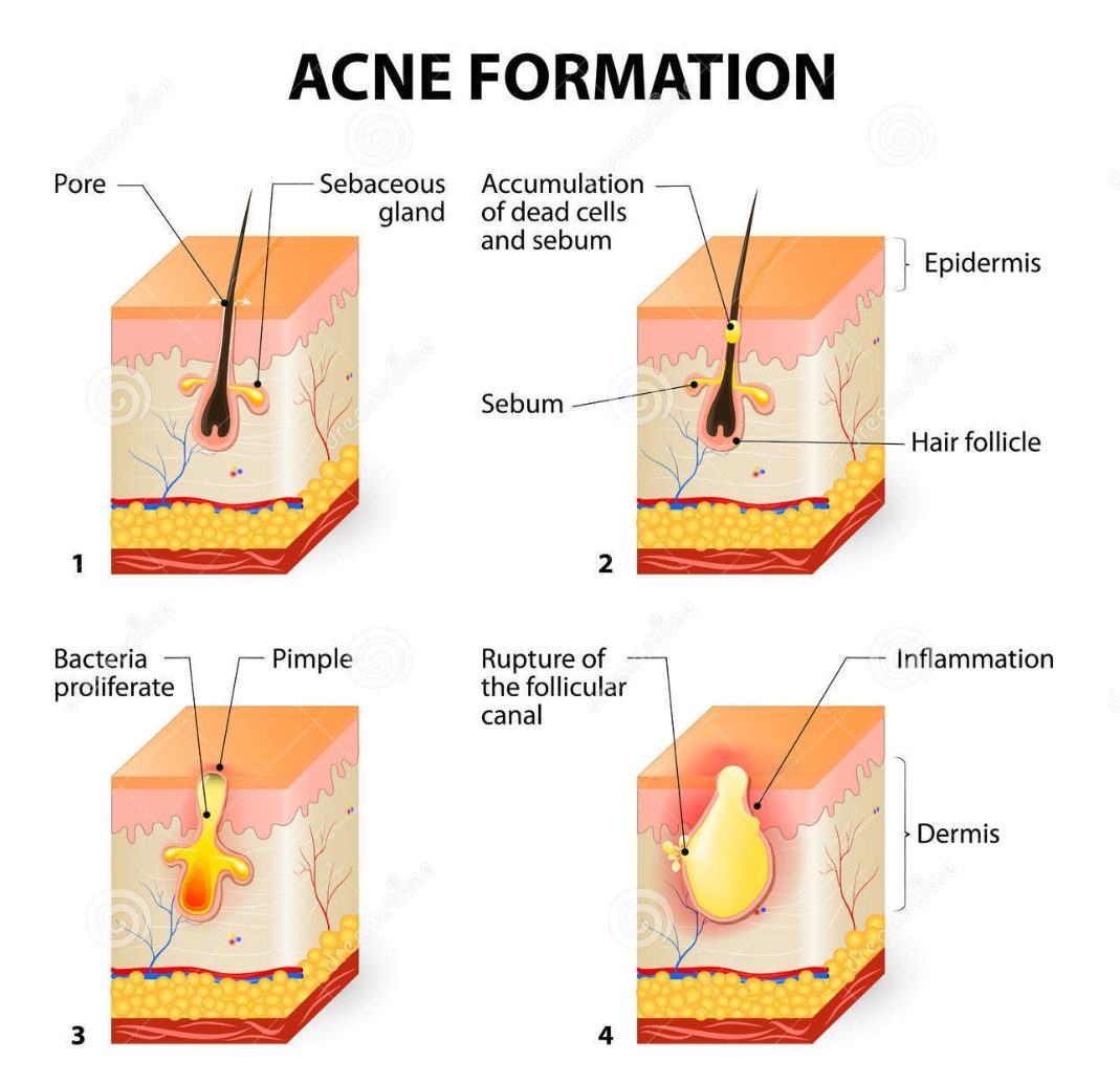 Image showing how acne forms