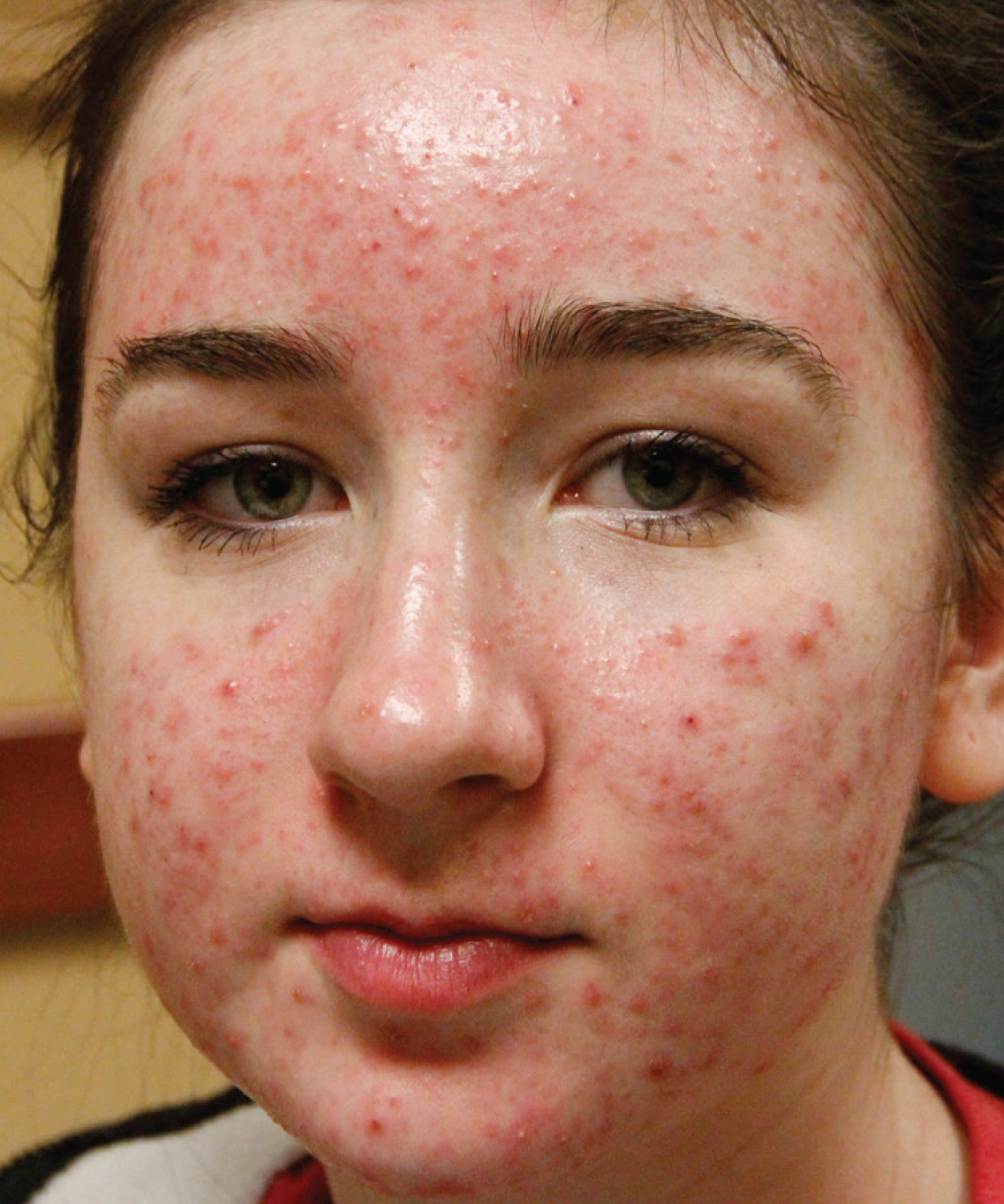 image showing girl with acne