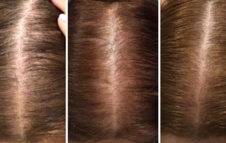 Hair Laser Before and after
