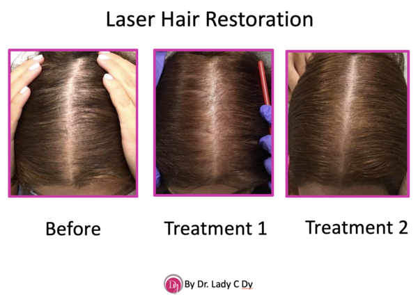 The New Wave of Hair Restoration Lasers - Dy Dermatology Center
