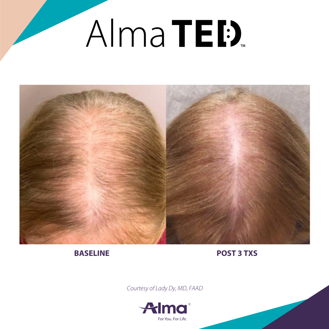Innovative Hair Growth Is Possible With Alma TED - Dy Dermatology Center